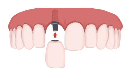 歯を1本失った場合