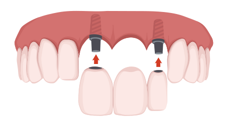 歯を複数失った場合