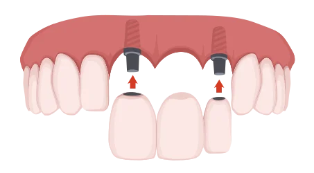 歯を複数失った場合