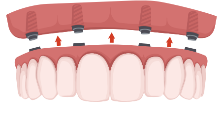 歯を全部失った場合