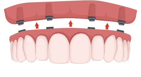 歯を全部失った場合